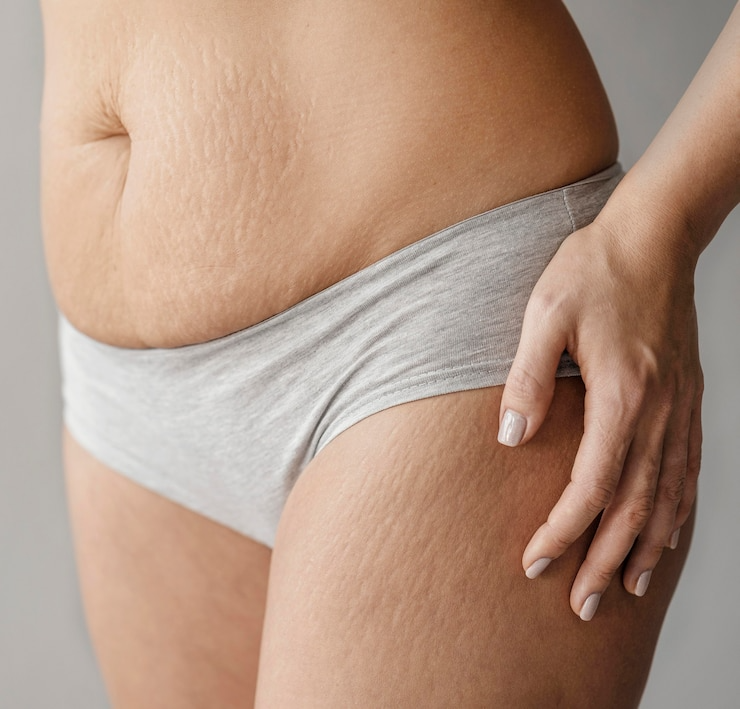 Does Stretch Mark Affect Your Beauty?