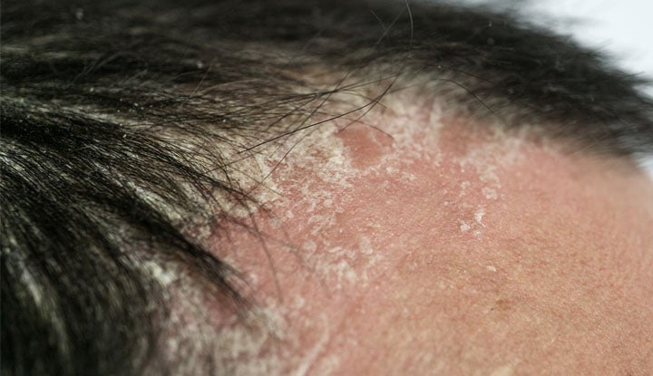 Scalp Psoriasis