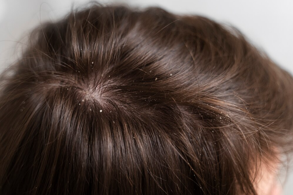 Scalp Psoriasis