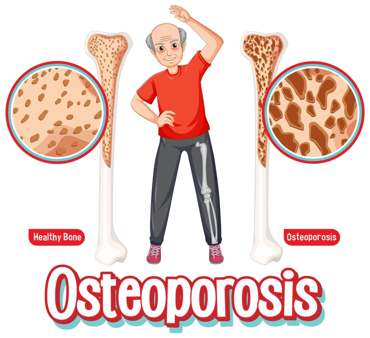 osteoporosis