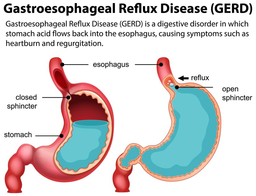 Gastroesophageal Reflux Disease (GERD)