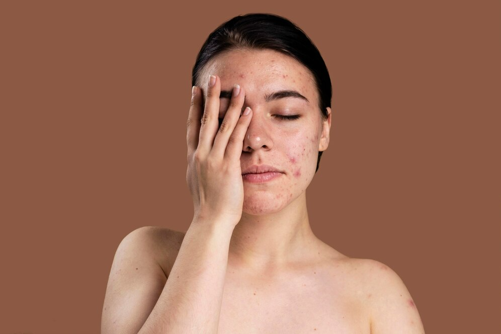 Ways to Treat Dry Skin Acne