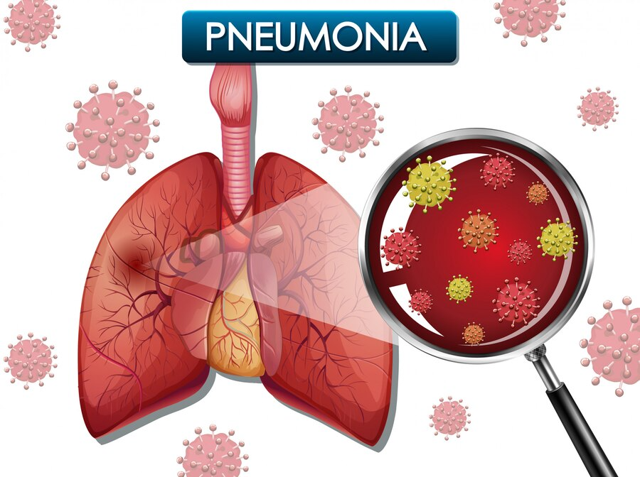 Influenza and pneumonia