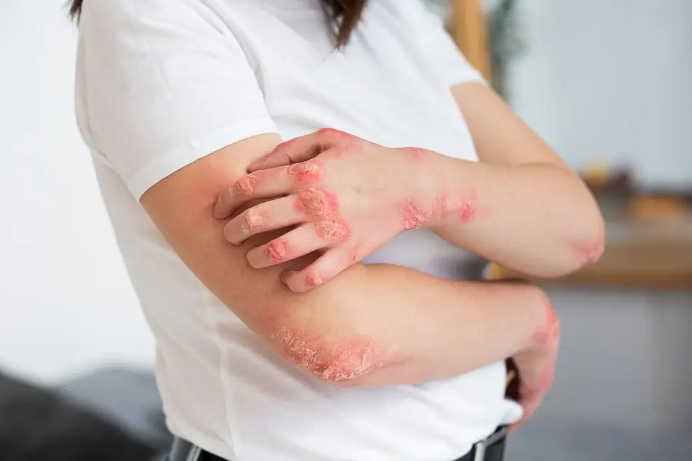 How To Cure Eczema Permanently?