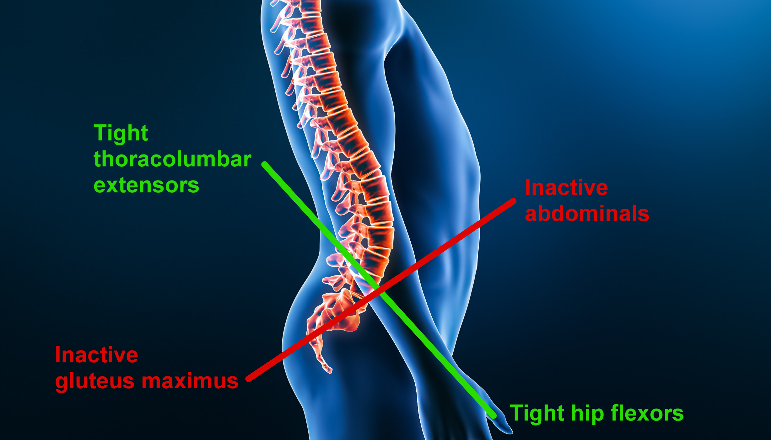 Lower Cross Syndrome